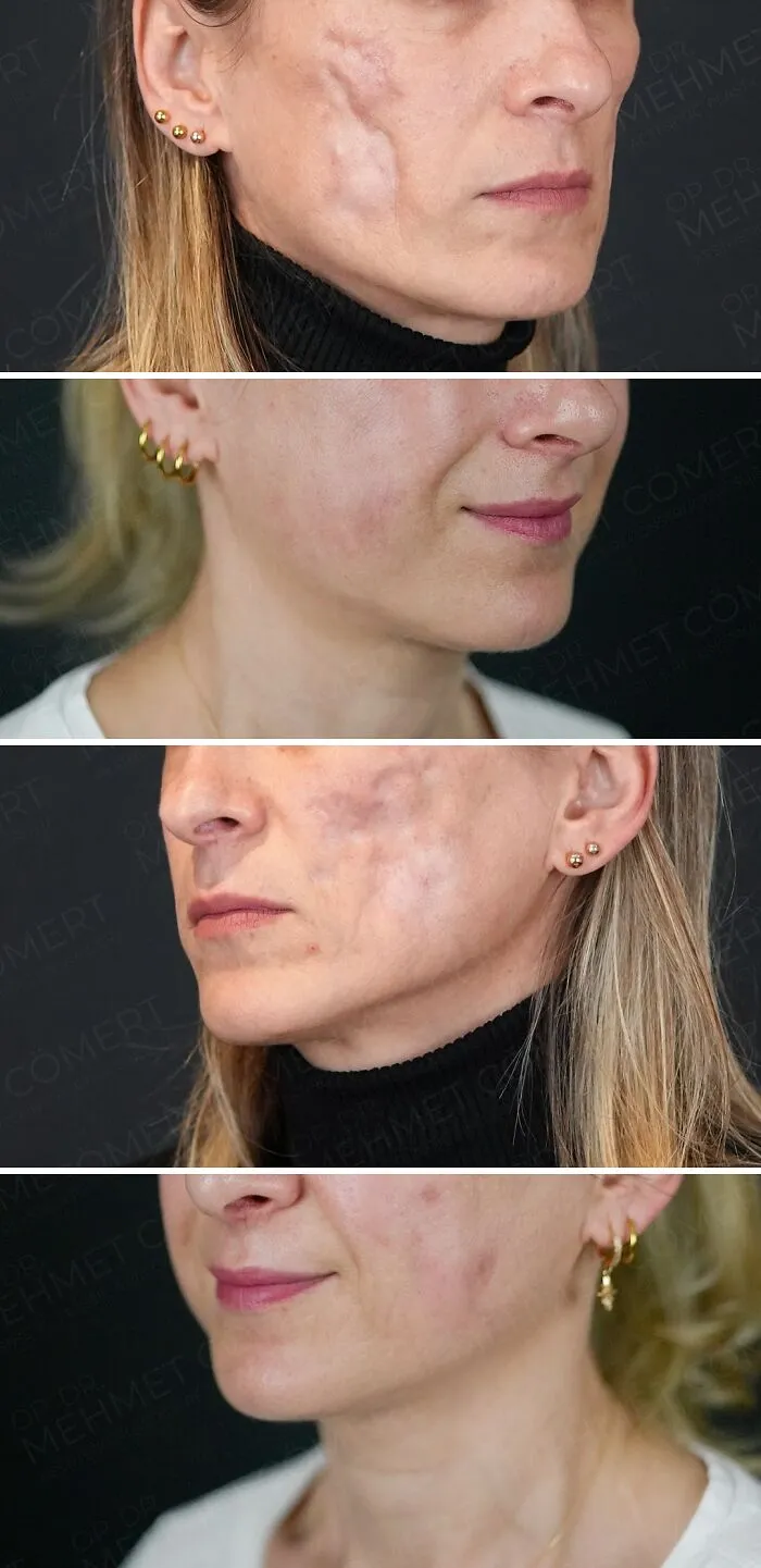 “Turning Back Time”: 50 Incredible Transformations From People Who Went Under The Knife To Change How They Look