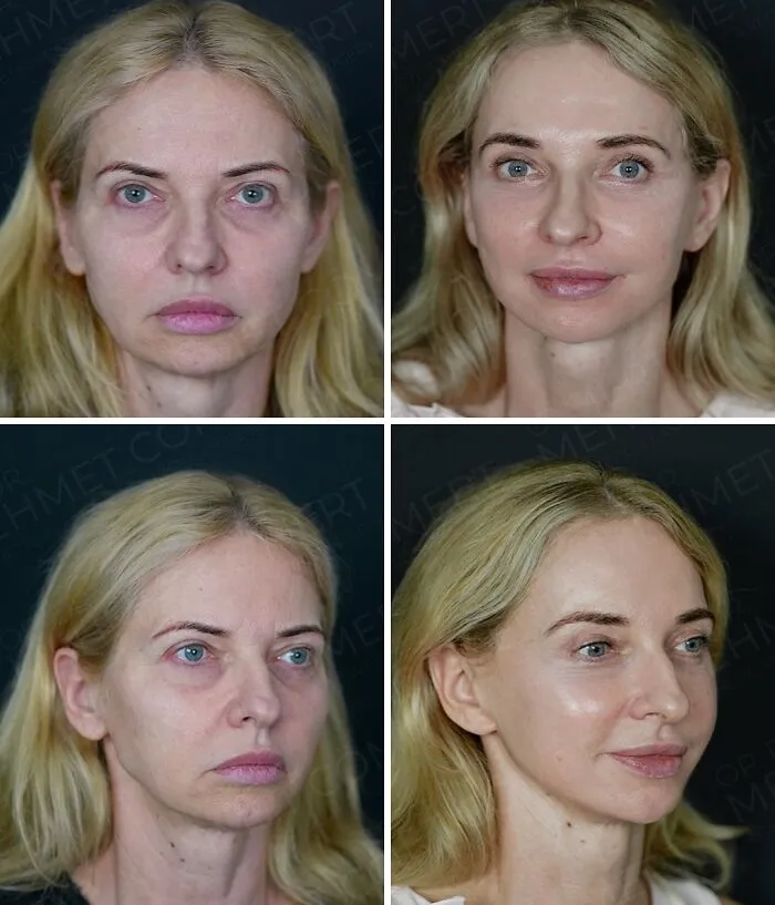 “Turning Back Time”: 50 Incredible Transformations From People Who Went Under The Knife To Change How They Look