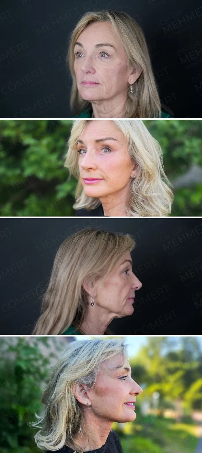 “Turning Back Time”: 50 Incredible Transformations From People Who Went Under The Knife To Change How They Look