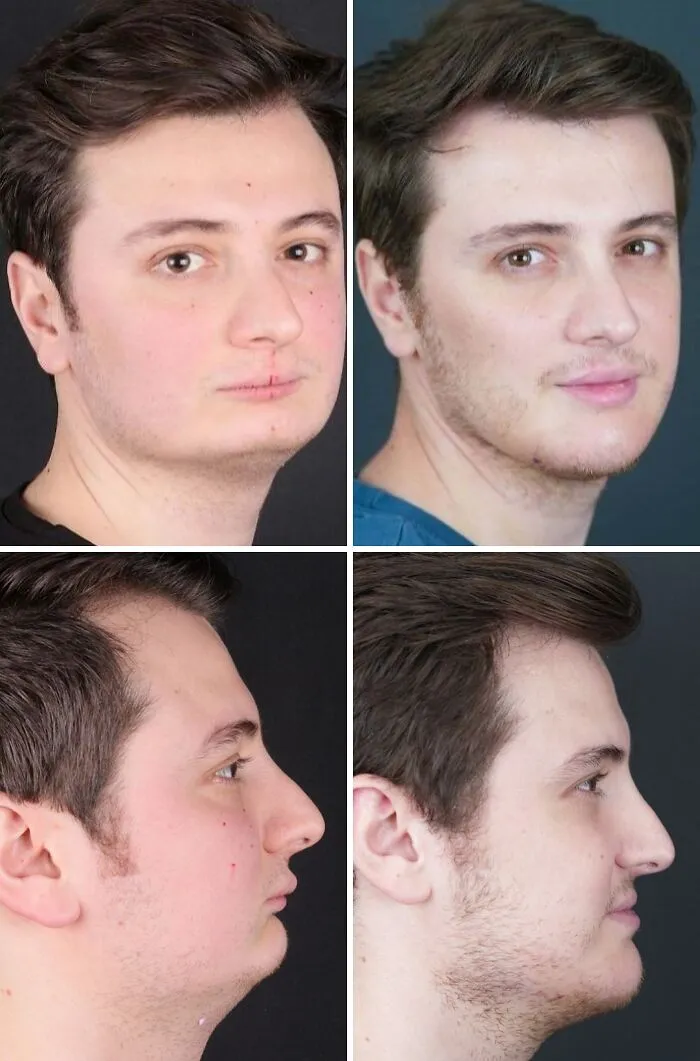 “Turning Back Time”: 50 Incredible Transformations From People Who Went Under The Knife To Change How They Look
