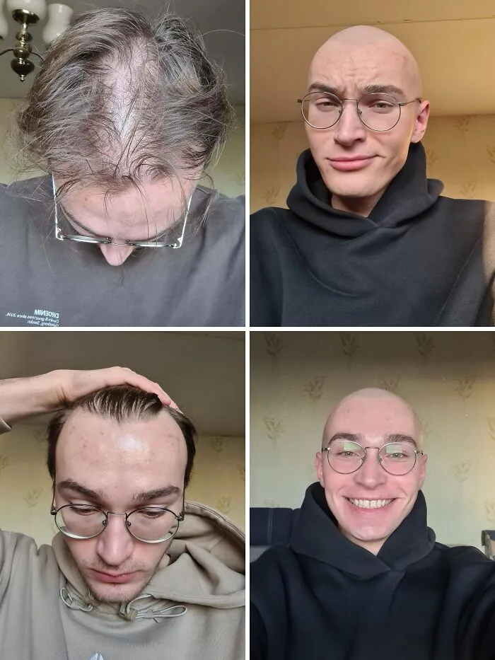 After More Than 4.5 Years Of Losing Hair And Feeling Insecure And Self-Conscious About It, I (22m) Finally Decided To Let It Go