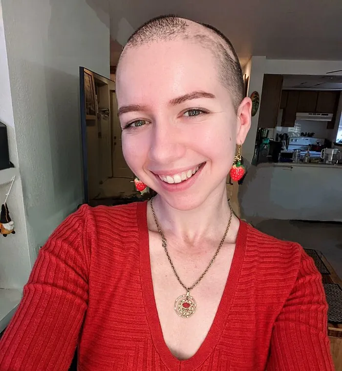 I'm No Longer Taking The Approved Alopecia Medicines Due To Harsh Side Effects. I've Decided To Fully Embrace The Fact That I'll Be A Patchy-Headed Princess And I'm Ok With That