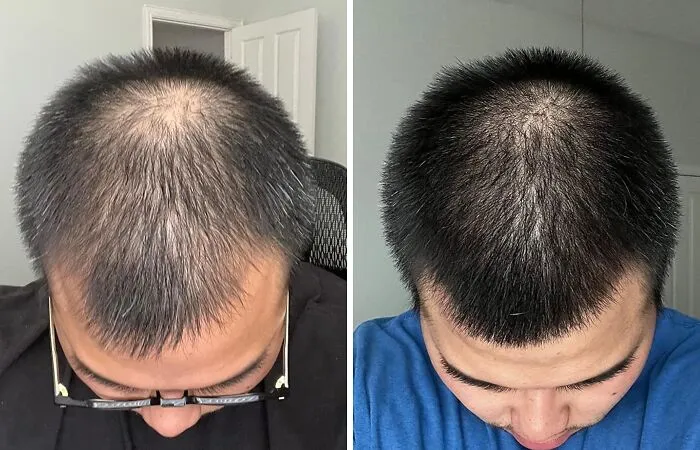  Convincing The World You Drink Enough Water And Eat Your Greens Is Surprisingly Simple When The <a Style="Display:inline;" Href="​​https://Www.amazon.com/Biotin-Hair-Shampoo-Thinning-Moisturizing/Dp/B01encboa0?ie=utf8&th=1&linkcode=ll1&tag=bpwhale-20&linkid=79e773c61fc1b27456c6a88f3bce76d9&language=en_us&ref_=as_li_ss_tl" Target="_blank">   <span Style="Font: Inherit; Color: #d74b1f;"> Rosemary And Biotin Shampoo </Span> Gives You That Healthy Shine Despite Your Diet Of Iced Coffee And Takeout
