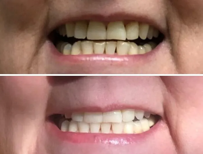  Blinding Your Enemies With A Dazzling Grin Is A Valid Self-Defense Strategy When You Use The <a Style="Display:inline;" Href="Https://Www.amazon.com/Venus-Visage-Effective%ef%bc%86painless-Sensitivity-Travel-Friendly/Dp/B082x2gsgj?ie=utf8&th=1&linkcode=ll1&tag=bpwhale-20&linkid=c9d5799375f9b2e3a43c204b9dc1f189&language=en_us&ref_=as_li_ss_tl" Target="_blank">   <span Style="Font: Inherit; Color: #d74b1f;"> Teeth Whitening Pen </Span> To Erase The Evidence Of Your Red Wine Habit