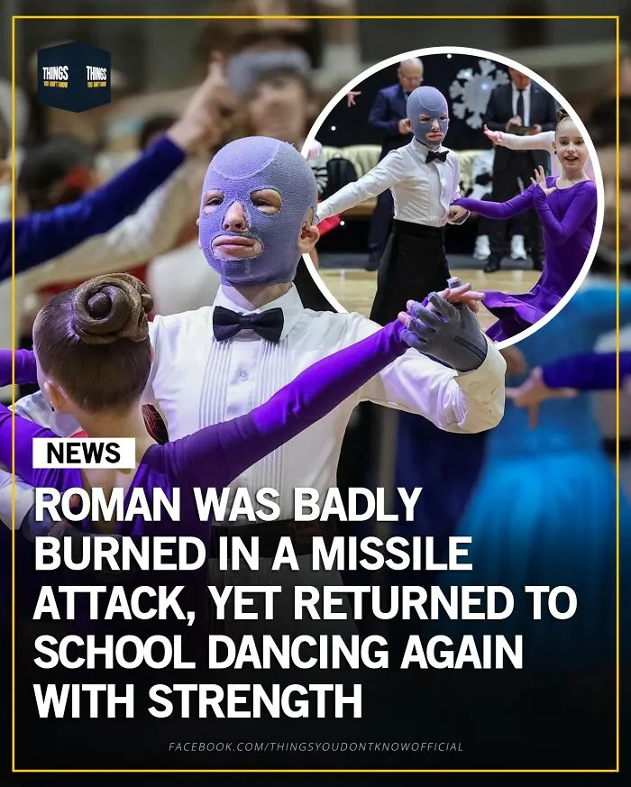 Young boy with burn mask and bow tie dancing at school, showcasing compelling facts and stories as conversation starters.