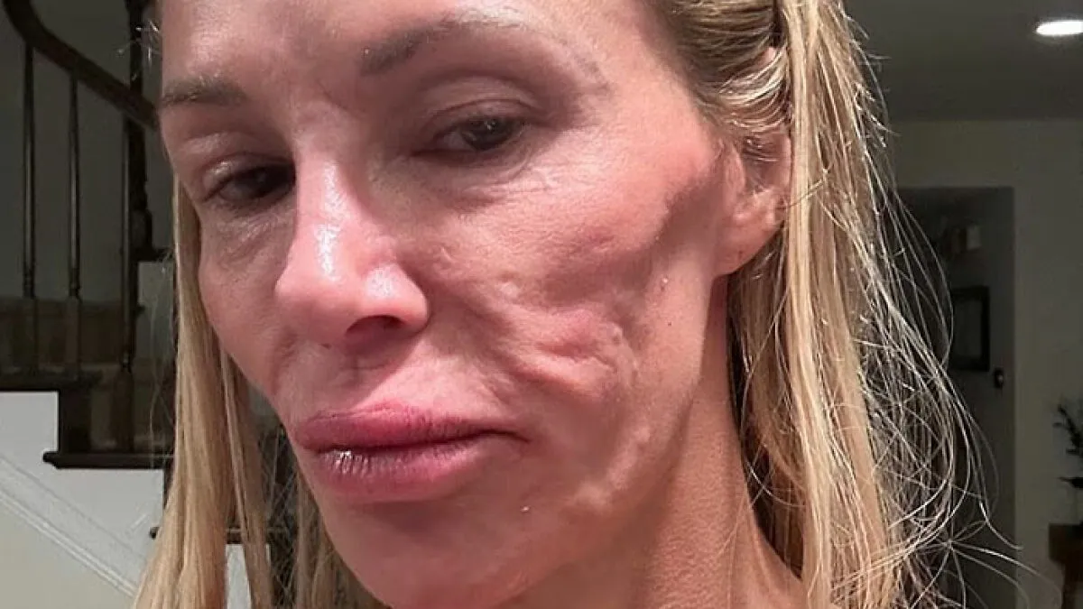 Brandi Glanville Finally Receives Diagnosis For Facial Disfigurement After Blaming A Parasite