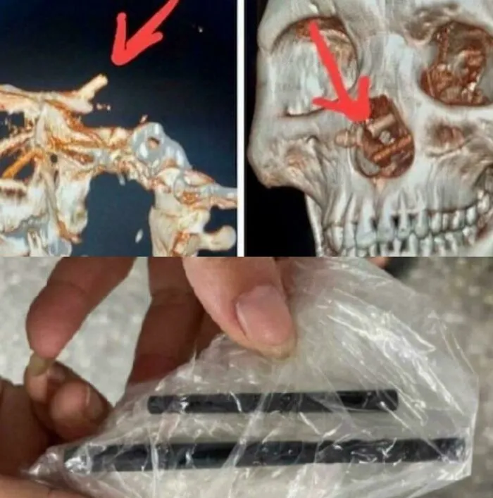 A Vietnamese Man Who Had Endured Severe Headaches For Five Months Was Shocked To Find Out That His Pain Was Caused By A Pair Of Chopsticks Lodged In His Skull, Likely Having Entered Through His Nose And Penetrated His Brain