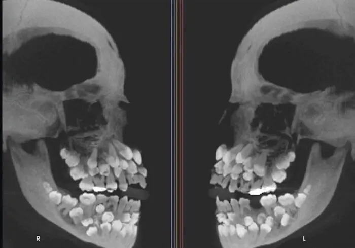 An X-Ray Of A Patient With Hyperdontia (The Condition Of Having More Teeth Than Average). Usually Adults Have 32 Teeth. This Person Had 81