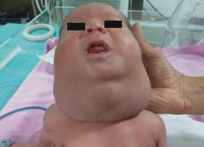 Bebé con infección grave en el cuello en hospital, imagen médica fascinante y perturbadora para estudios médicos.