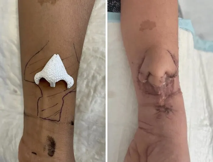 Los médicos imprimieron con éxito en 3D una nueva nariz para este paciente con cáncer, se la implantaron en el antebrazo y luego la reimplantaron donde corresponde.