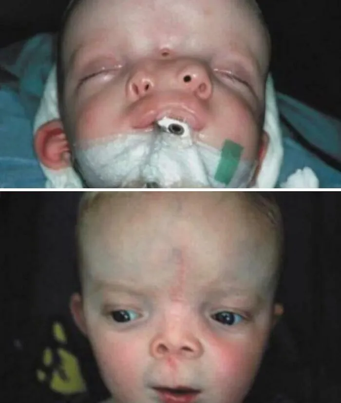 Antes y después de la cirugía por duplicación craneofacial