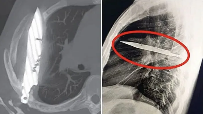 Un hombre de 44 años llegó al hospital con una extraña herida en el pecho. Durante el examen, los médicos descubrieron que una hoja de cuchillo llevaba ocho años alojada en su pecho, sin que él lo supiera.