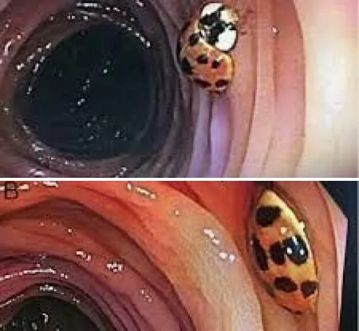 Durante una colonoscopia realizada a un hombre de 59 años, se encontró un huésped inesperado en su intestino.