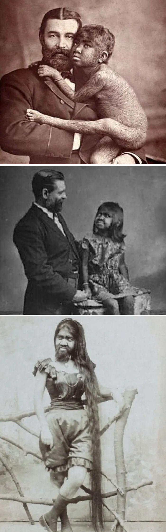 Krao Farini, An 'Adopted' Sideshow Performer Born In 1876. She Had Hypertrichosis (Excess Hair) And Was Said To Be The Missing Link Between Apes And Humans