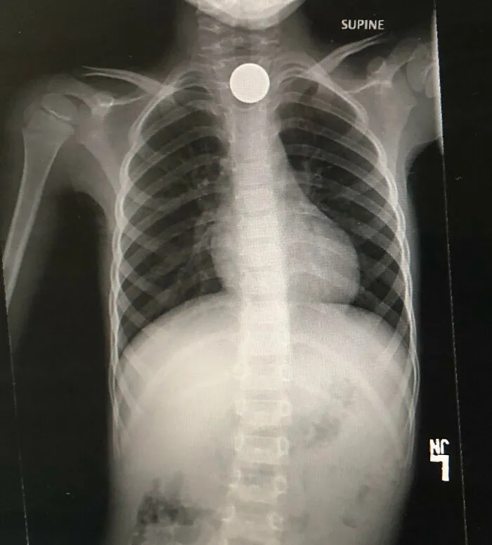 Radiografía mostrando un error costoso con un objeto metálico atrapado en el esófago, ejemplo de errores caros sorprendentes.