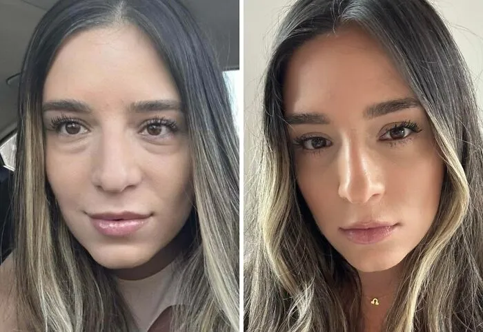 ¡Tres semanas después de la operación! (Blefaroplastia inferior)