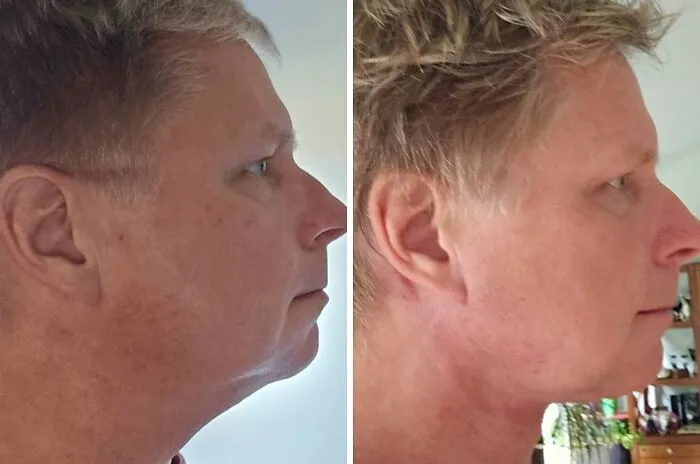 One Month Post Neck Lift