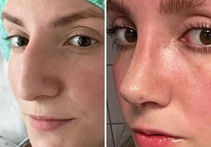 Antes y después de la rinoplastia