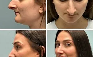 41 Striking Before-And-After Photos Of Plastic Surgery That Seriously Changed People’s Looks
