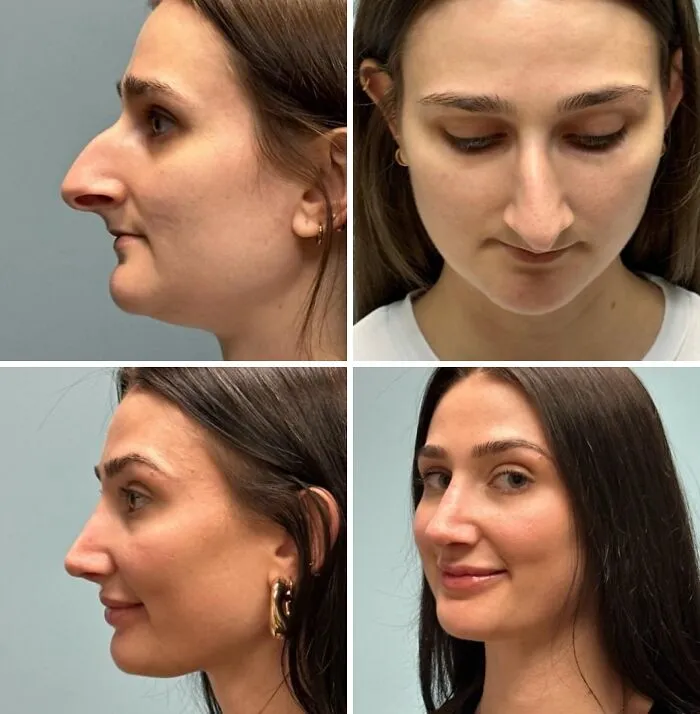 I Got A Nose Job & Lip Filler
