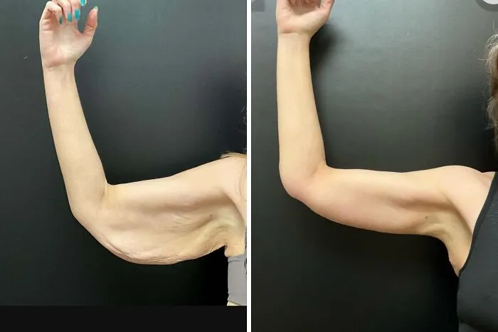 Braquioplastia antes y después