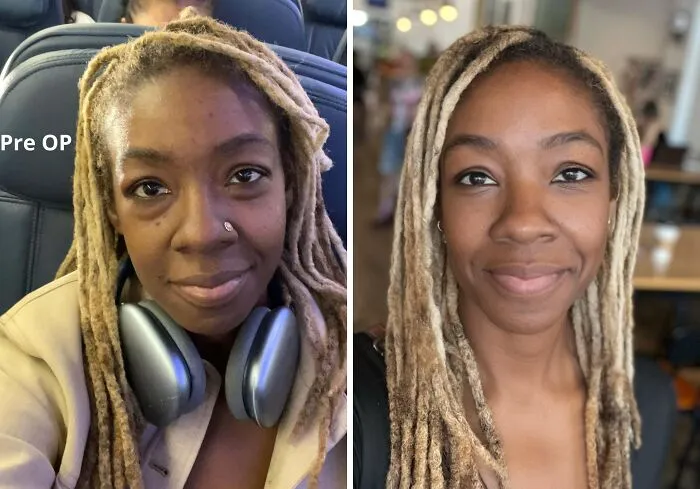 Blefaroplastia inferior, 17 días después de la operación