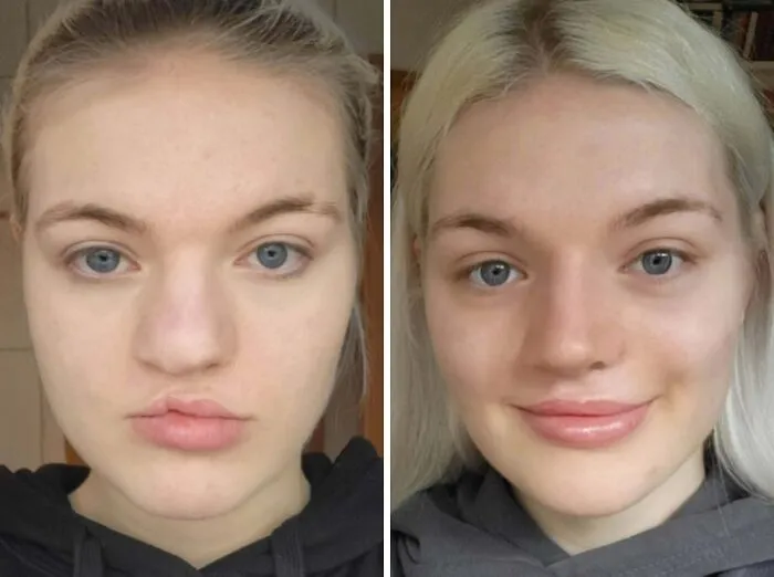 ¡Rinoplastia para mi labio y paladar hendido!