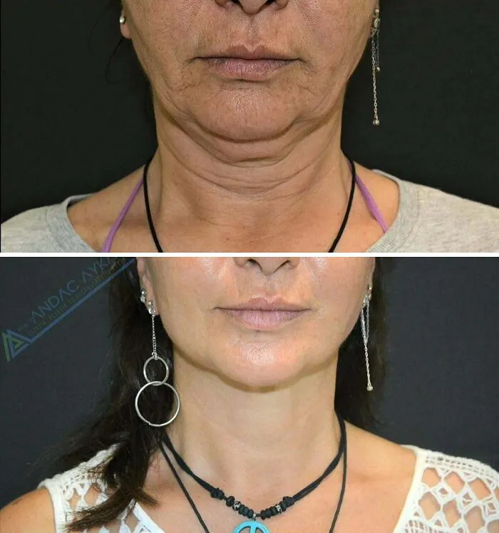 Face And Neck Lift