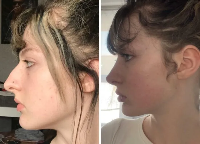 1 año tras la rinoplastia