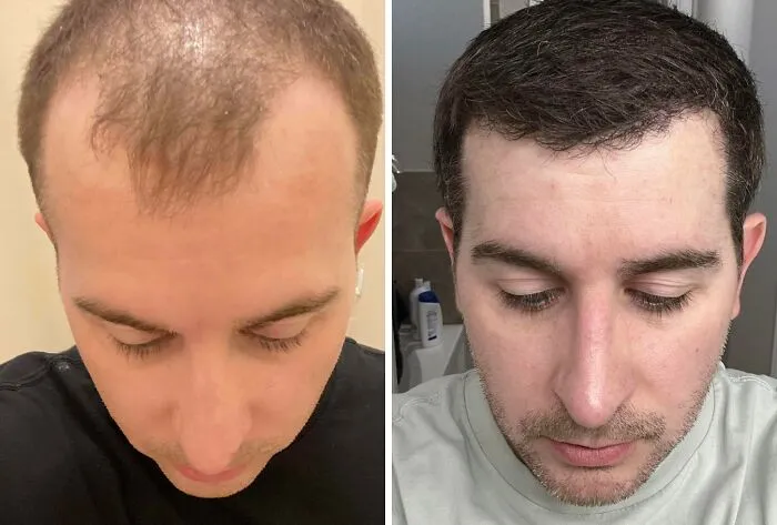 5 Months Post Hair Transplant