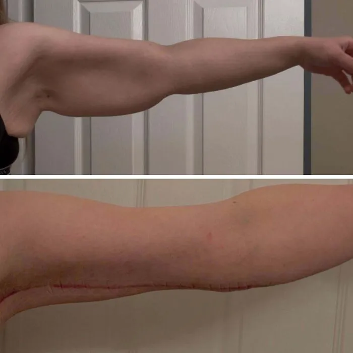 ¡Actualización! Aproximadamente 11 semanas después de una braquioplastia bilateral tras perder más de 70 kg. ¡El alivio que siento al no tener que soportar más mis brazos a diario es indescriptible!