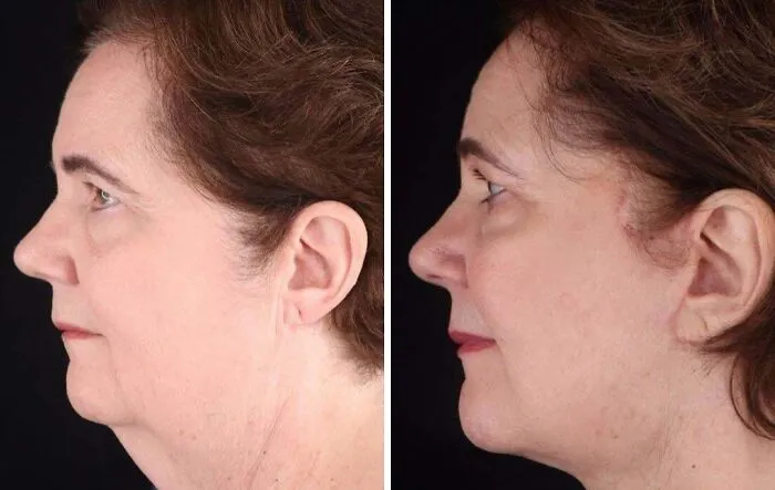 Lifting facial y de cuello profundo a los 3 meses de la operación: todo realizado en el consultorio.