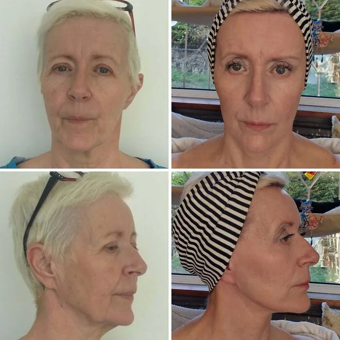 Muy satisfecha, 6 meses después del lifting de la parte inferior del rostro y cuello. Lifting temporal de un lado para corregir asimetría la semana pasada.