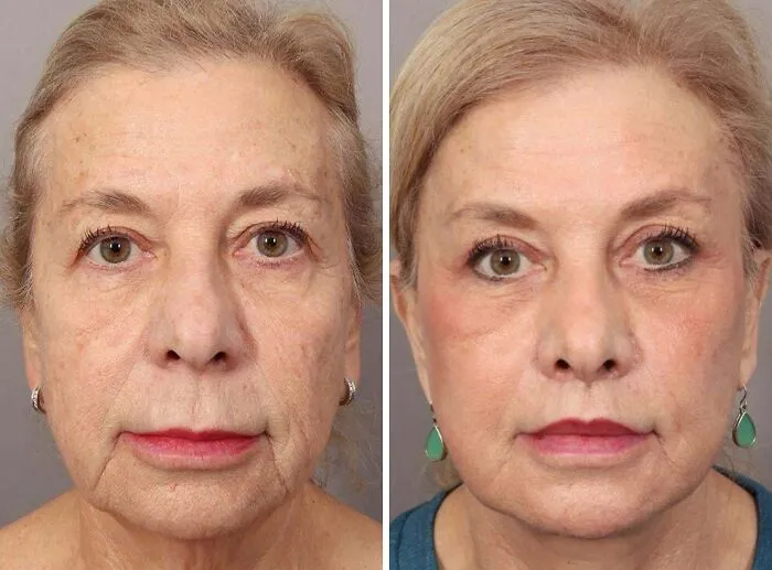 Actualización: 2 meses después de la operación: lifting facial profundo  (70 años)