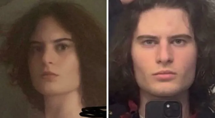 FTM, Facial Masculinization Surgery Fully Recovered 1 Year Later