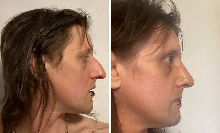1 semana tras mi rinoplastia