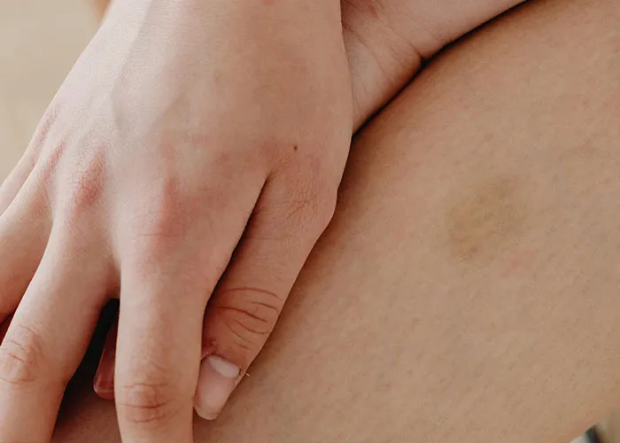 Close-up of a hand resting on a leg showing rare physiological traits and subtle skin discoloration.