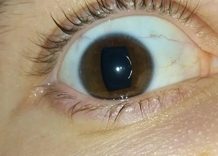 Close-up of a human eye showing a rare physiological trait with an unusual rectangular pupil shape.