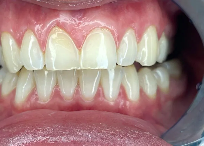 Close-up of rare physiological teeth trait showing abnormal tooth shape and alignment inside a human mouth.