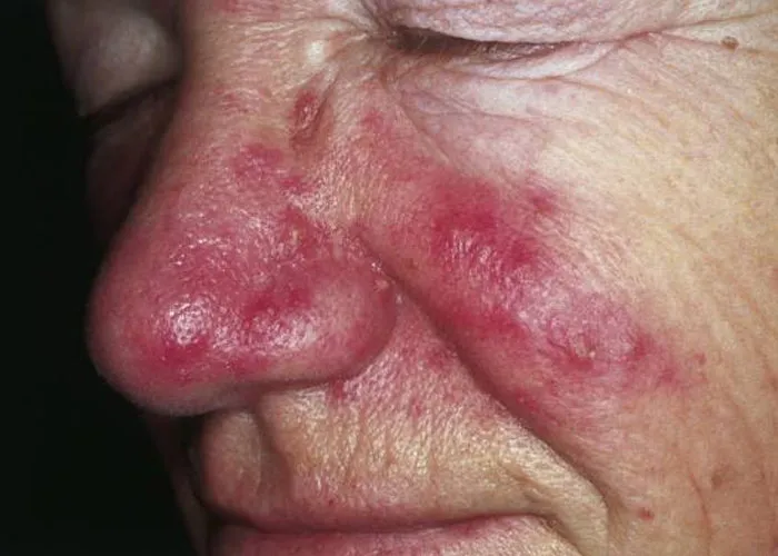 Close-up of a person's face with red, inflamed skin showing signs of severe medical skin issues.