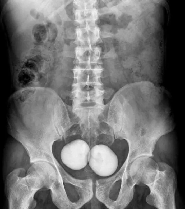 X-ray image showing abnormal large kidney stones in the pelvic area from a fascinating medical pics collection.