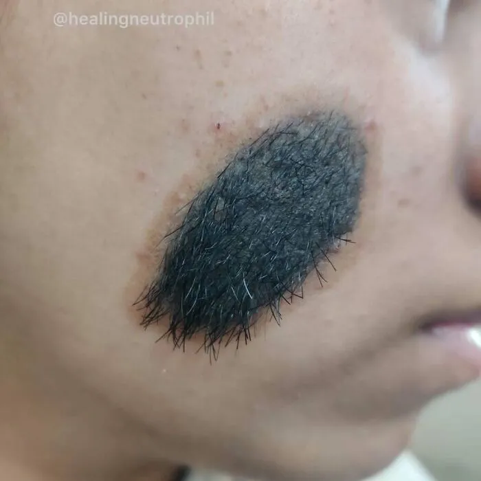 Close-up of unnerving medical pic showing an unusual patch of thick, dark hair on a person’s cheek.