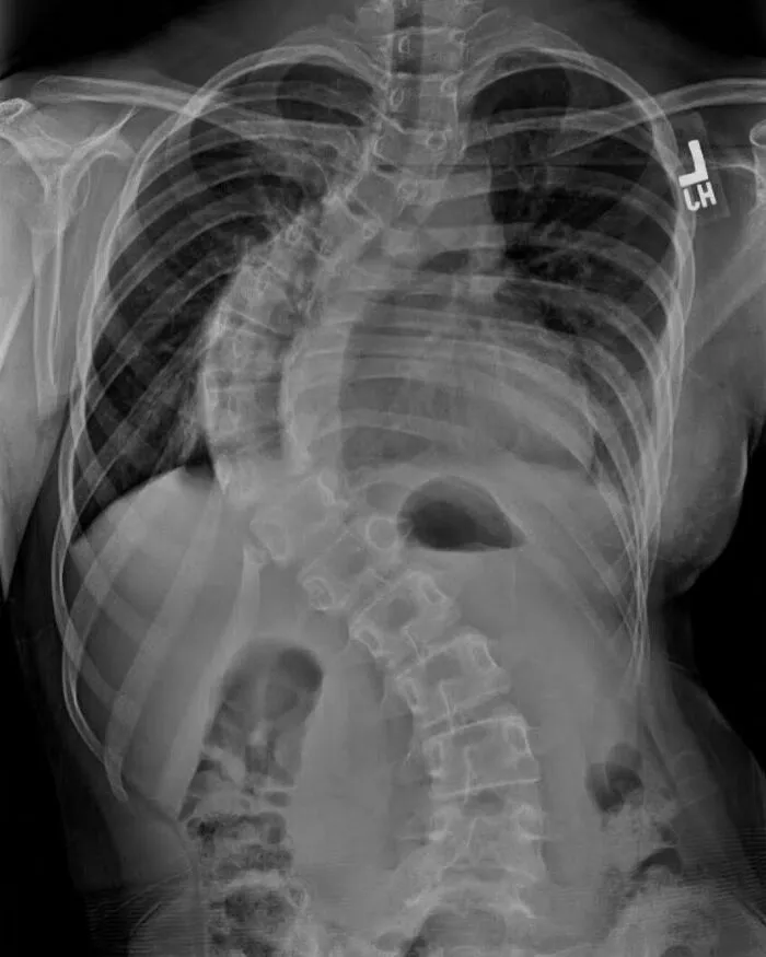 X-ray showing spine with severe scoliosis, one of the fascinating and unnerving medical pics to process.