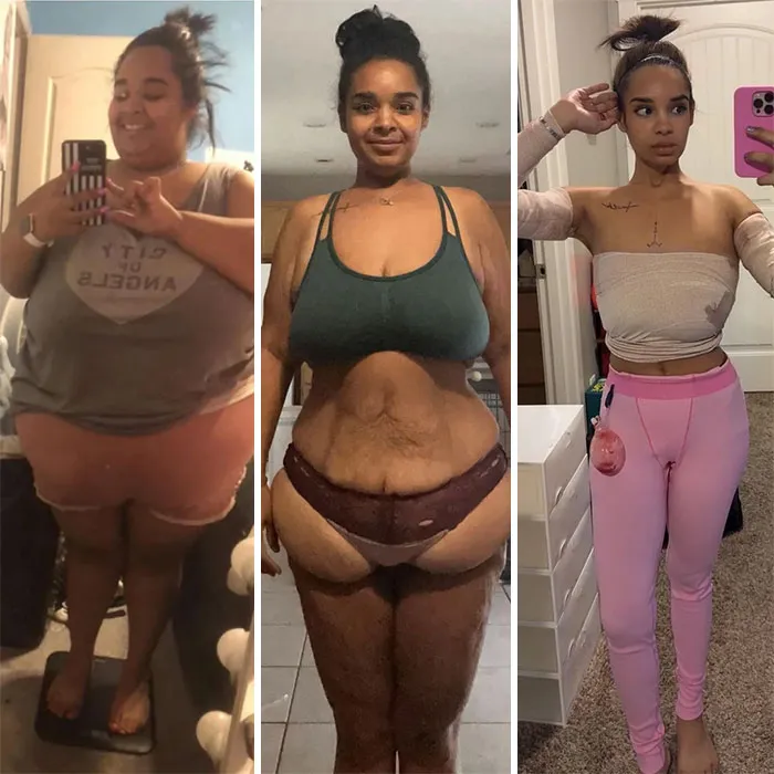 Eliminación de piel flácida de la parte superior e inferior del cuerpo