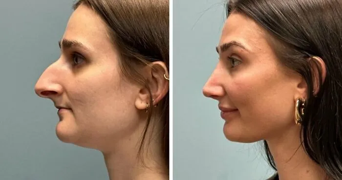 25 Personas que se ven irreconocibles tras su cirugía plástica