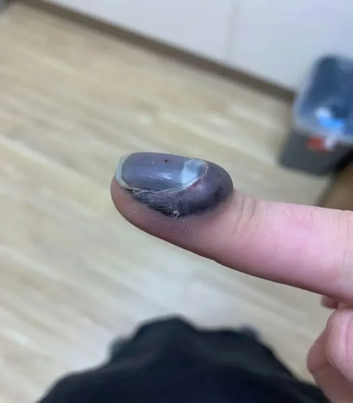 Mi dedo tras pillármelo con la puerta del coche