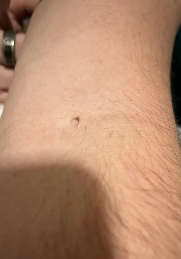 Pequeña quemadura en la piel, ejemplo de gente que tuvo un peor día que tú en situaciones inesperadas.