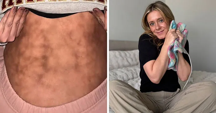 "She's Literally Cooking Herself": Woman With 'Toasted Skin Syndrome' Goes Viral