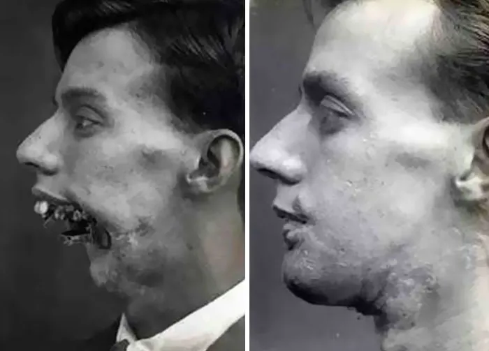 Facial Reconstructive Surgery From 1916