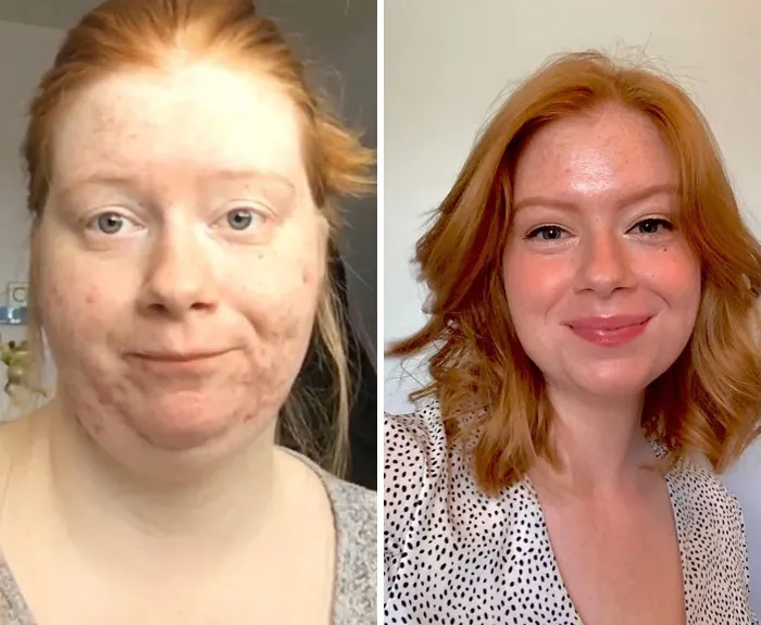 F/22/5’5 [190 > 129 = -61lbs] I Used To Be Afraid Of Having Short Hair Cause Of The Weight In My Face. Today, I Said Goodbye To The Old Me And Embraced My New Life!